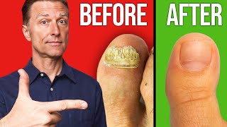 Thumbnail for How to Get Rid of Toenail Fungus Fast! | Dr. Eric Berg DC