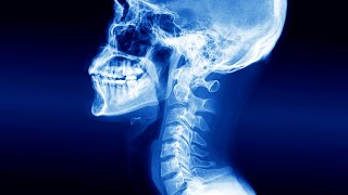 Thumbnail for A Man Swallowed Wireless Earbud. This Is What Happened To His Esophagus. | Chubbyemu