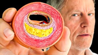 Thumbnail for #1 Best Way to Find CLOGGED Arteries | Thomas Fordham Brewer MD MPH