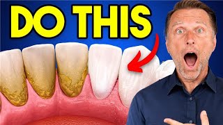 Thumbnail for The #1 BEST Remedy for Dental Plaque (TARTAR) | Dr. Eric Berg DC